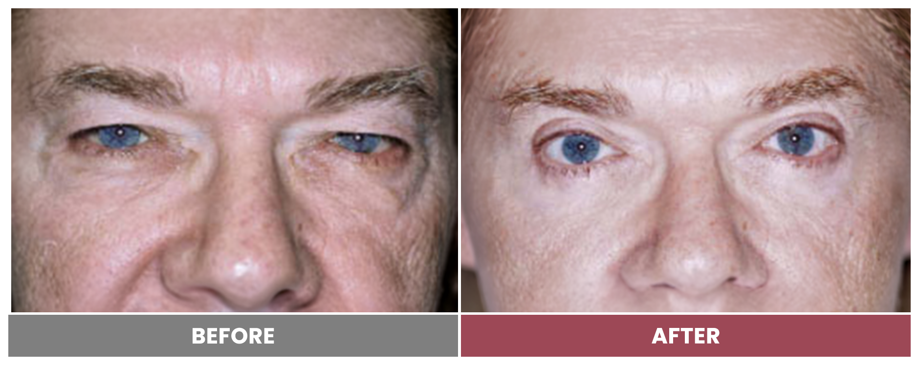 Upper Blepharoplasty - Case 93